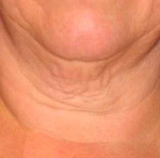 Antes