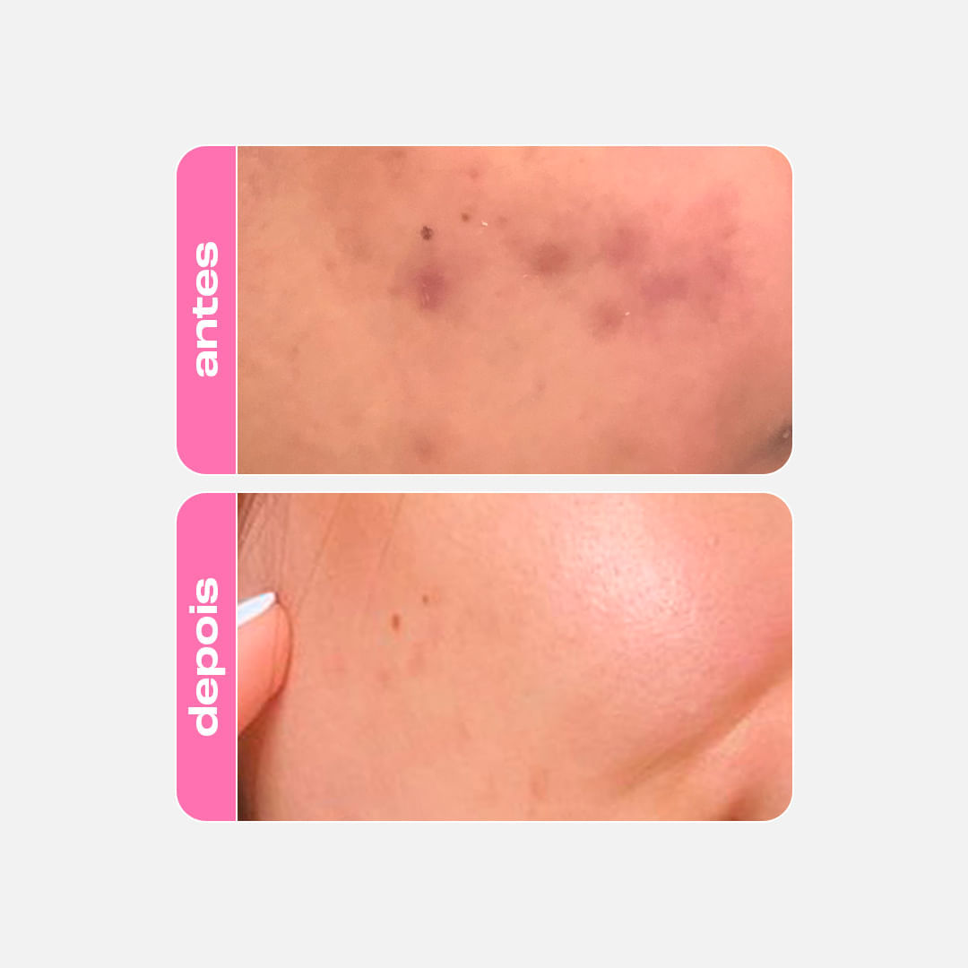 Sérum Fortalecedor Antioleosidade - Niacinamide B